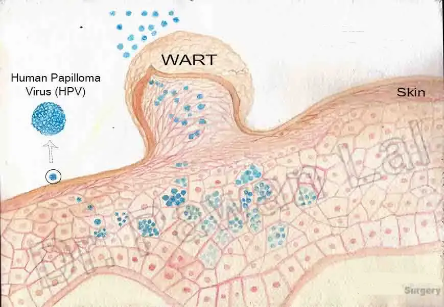 warts HPV